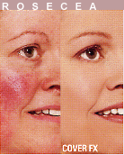 rosacea